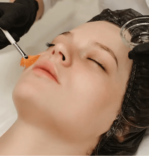 Chemical Peels
