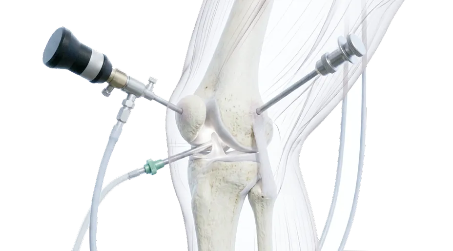 Medical illustration of a knee joint undergoing arthroscopic surgery with inserted surgical instruments.