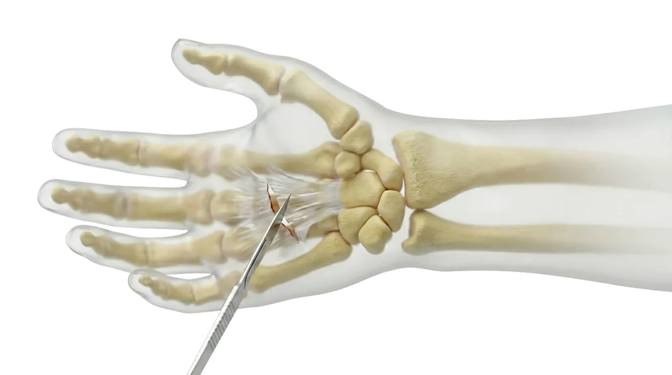 3D medical illustration of a human hand skeleton showing a cut through the ligaments between carpal bones with a surgical scalpel.