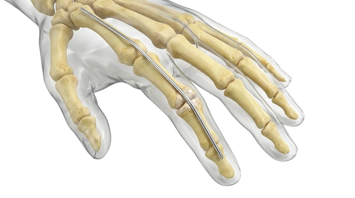 3D medical visualization of a hand skeleton highlighting the insertion of a metal pin inside the finger bones.