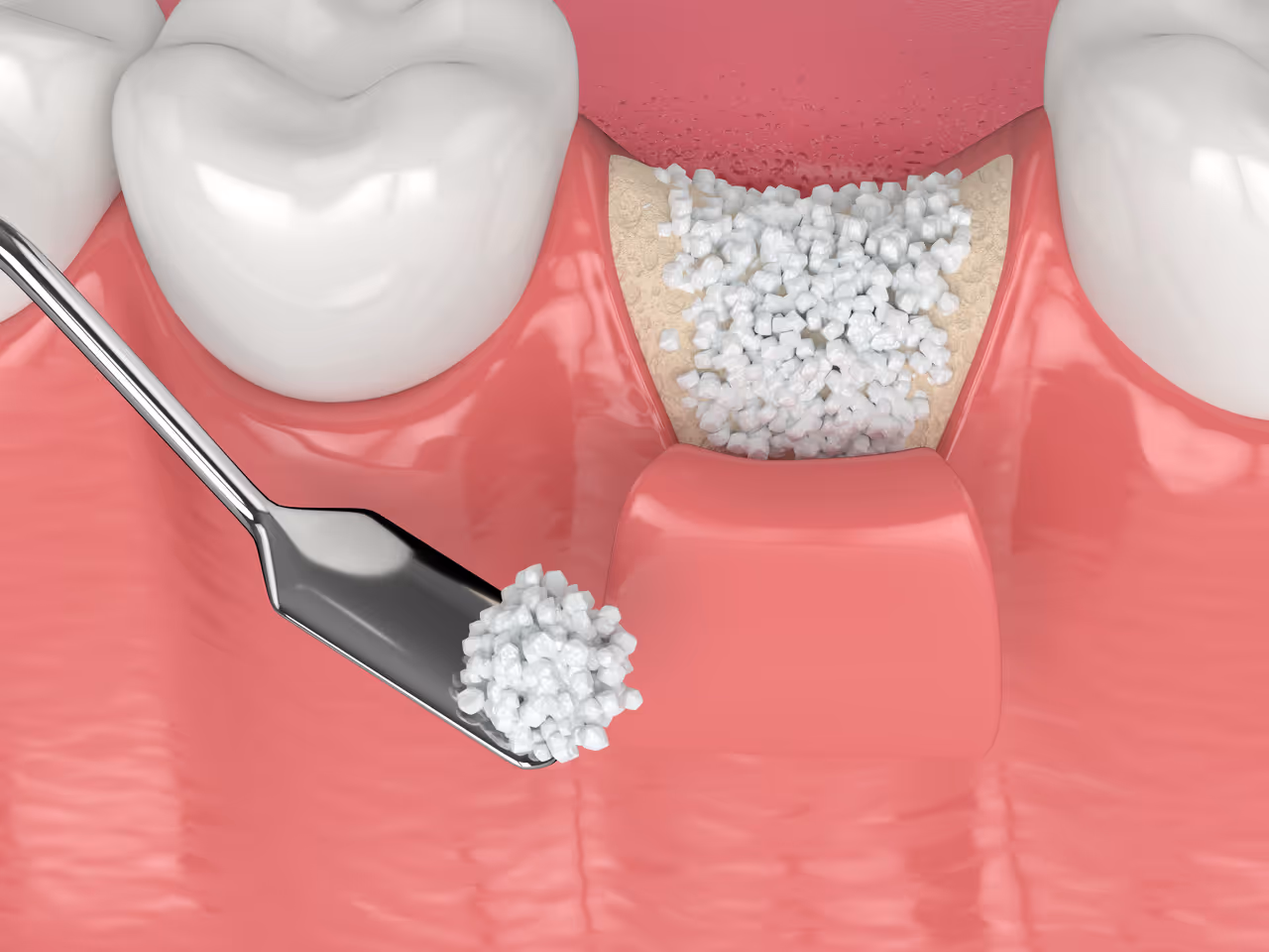 Bone Grafting