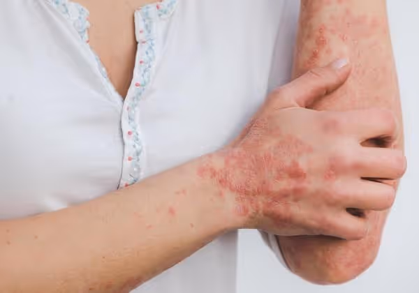 Red, inflamed psoriasis patches on a person’s arm and hand