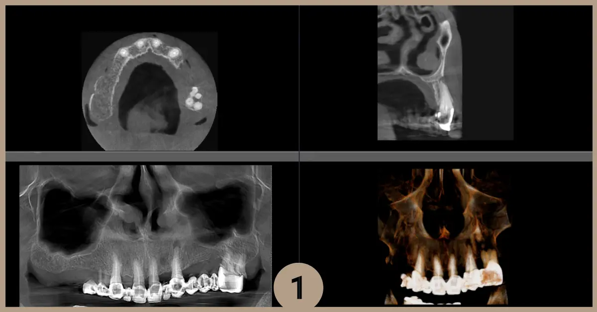 inserare-implant-cbct
