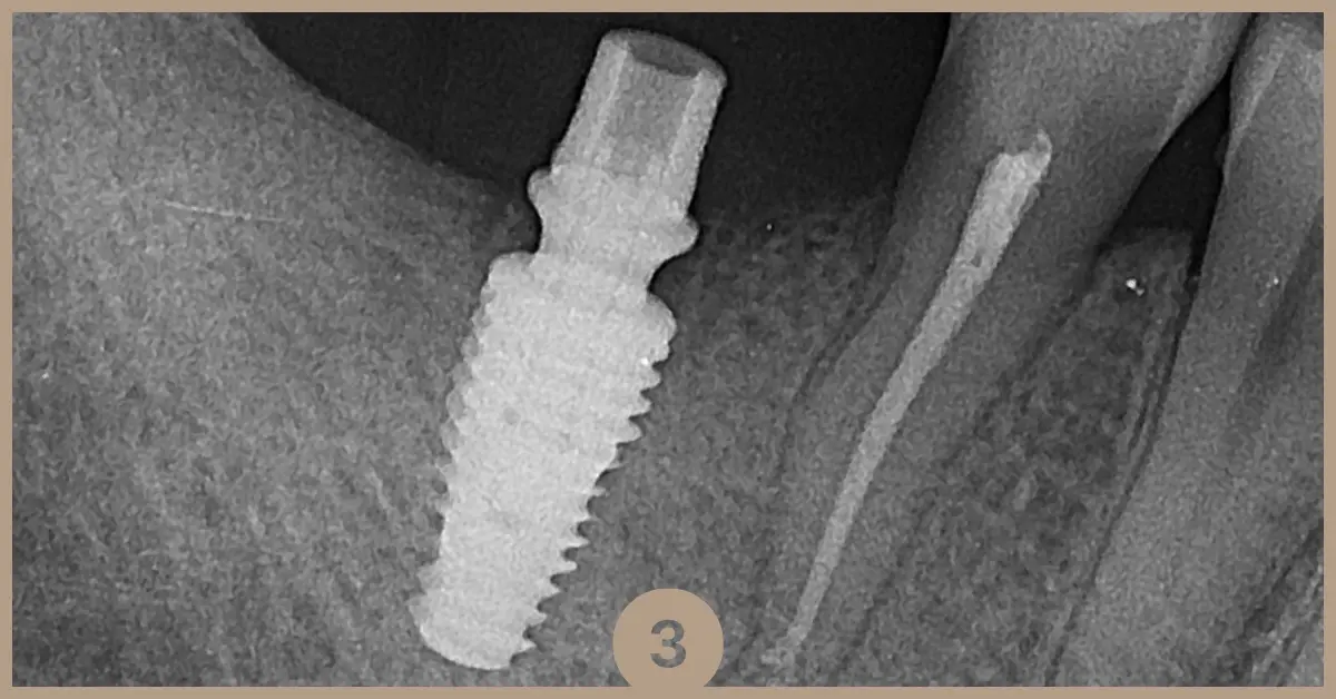 implant-dentar-osteointegrare