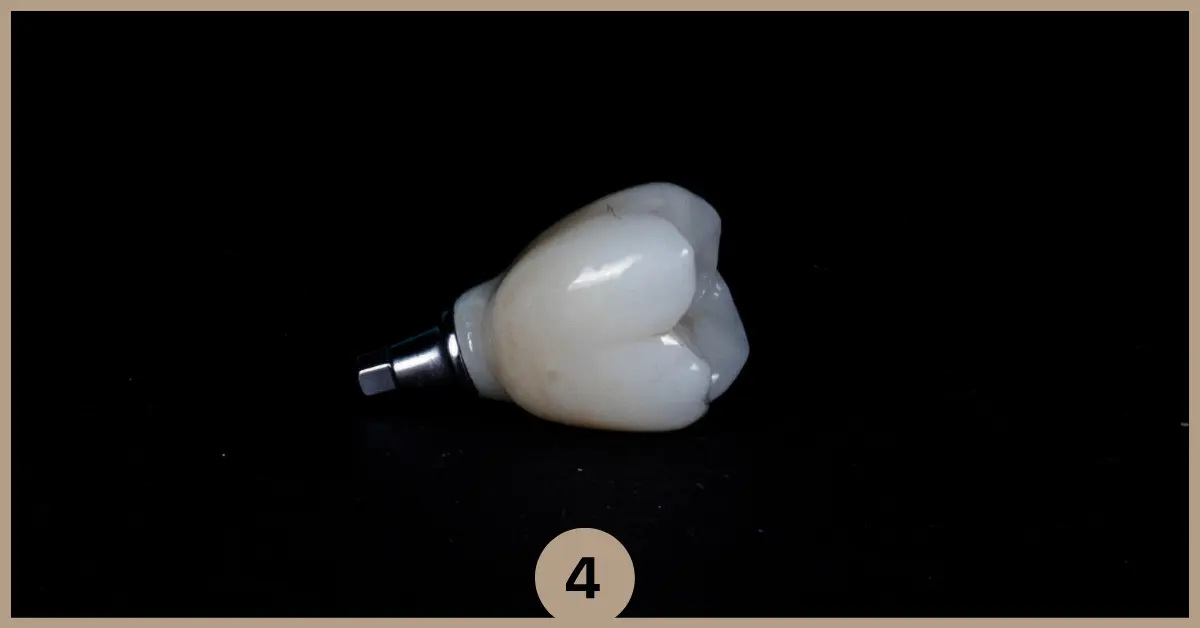 inserare-implant-coroana