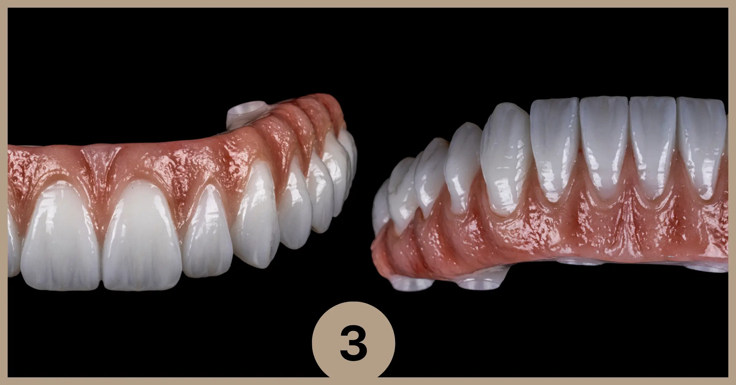 fixare-lucrare-dupa-implant-dentar-allon4-allon6