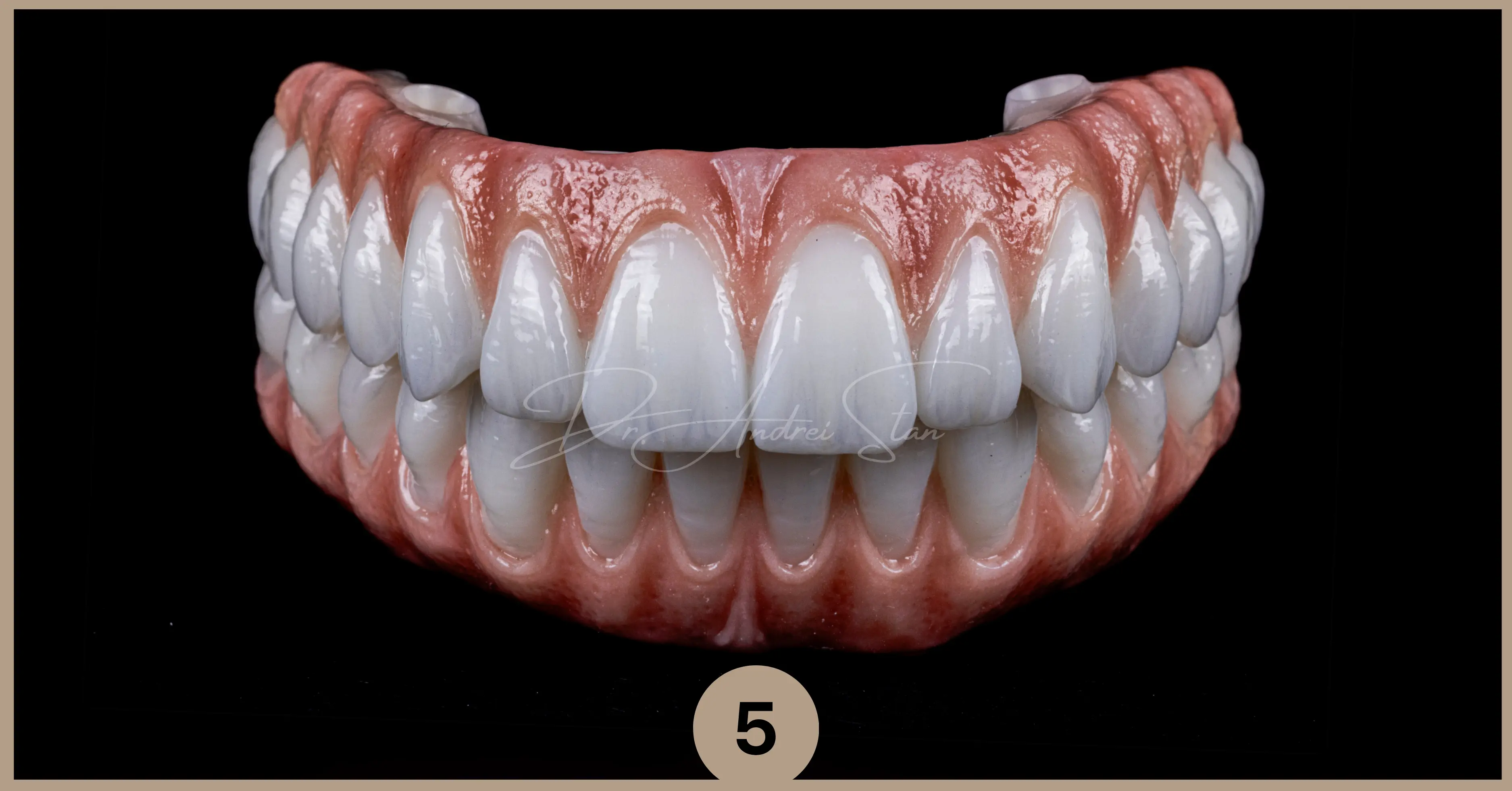 dantura-fixa-finala-zirconiu-titan-allon4-allon6