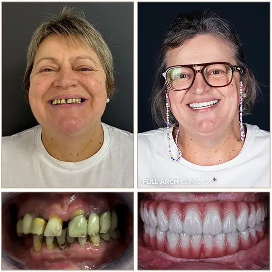inaite-dupa-pacient-tratament-cu-implanturi-dentare-allon4-allon6
