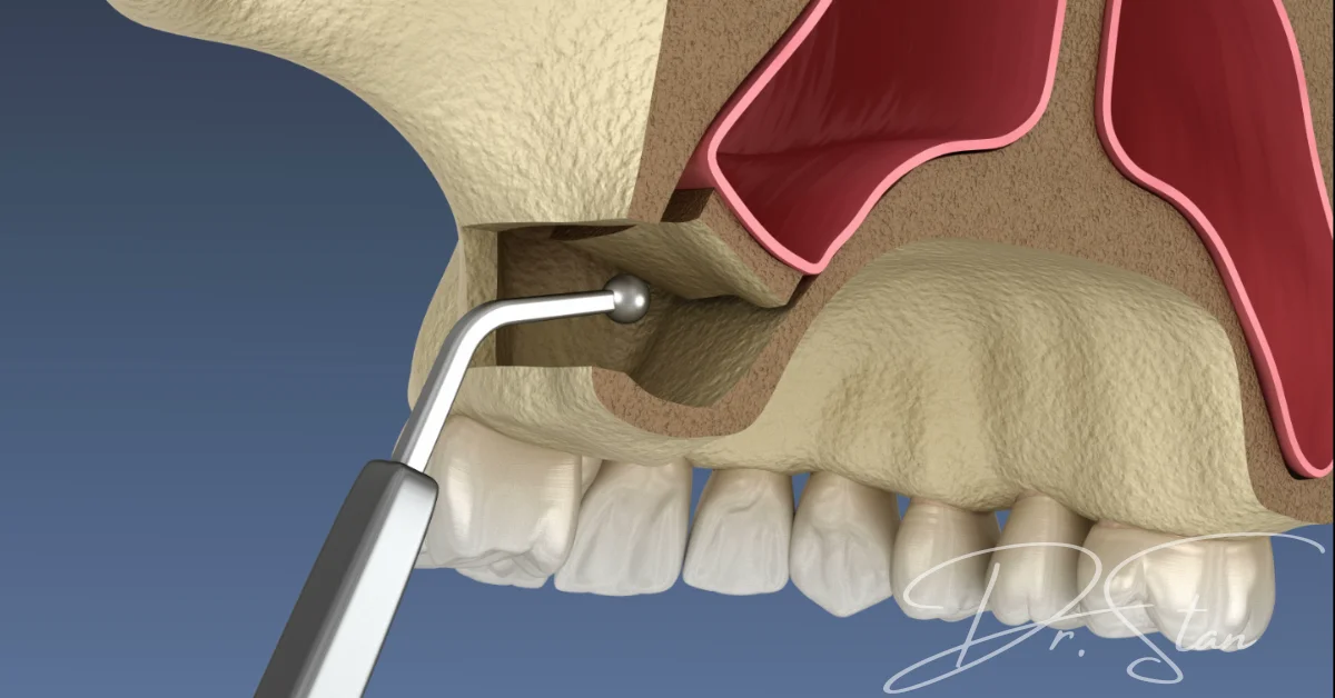 operatia-de-sinus-lift-extern-dr-andrei-stan-cluj-napoca