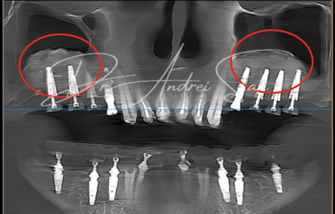 sinus-lift-cu-implant-dentar-cluj-napoda-dr-andrei-stan