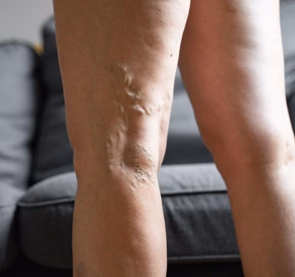 ¿Por Qué Siempre Tengo las Piernas Hinchadas? Causas, Síntomas y Cuándo Preocuparte