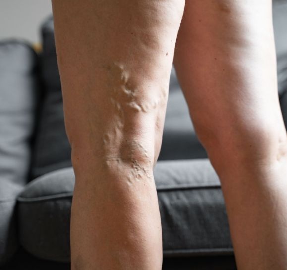 ¿Por Qué Siempre Tengo las Piernas Hinchadas? Causas, Síntomas y Cuándo Preocuparte