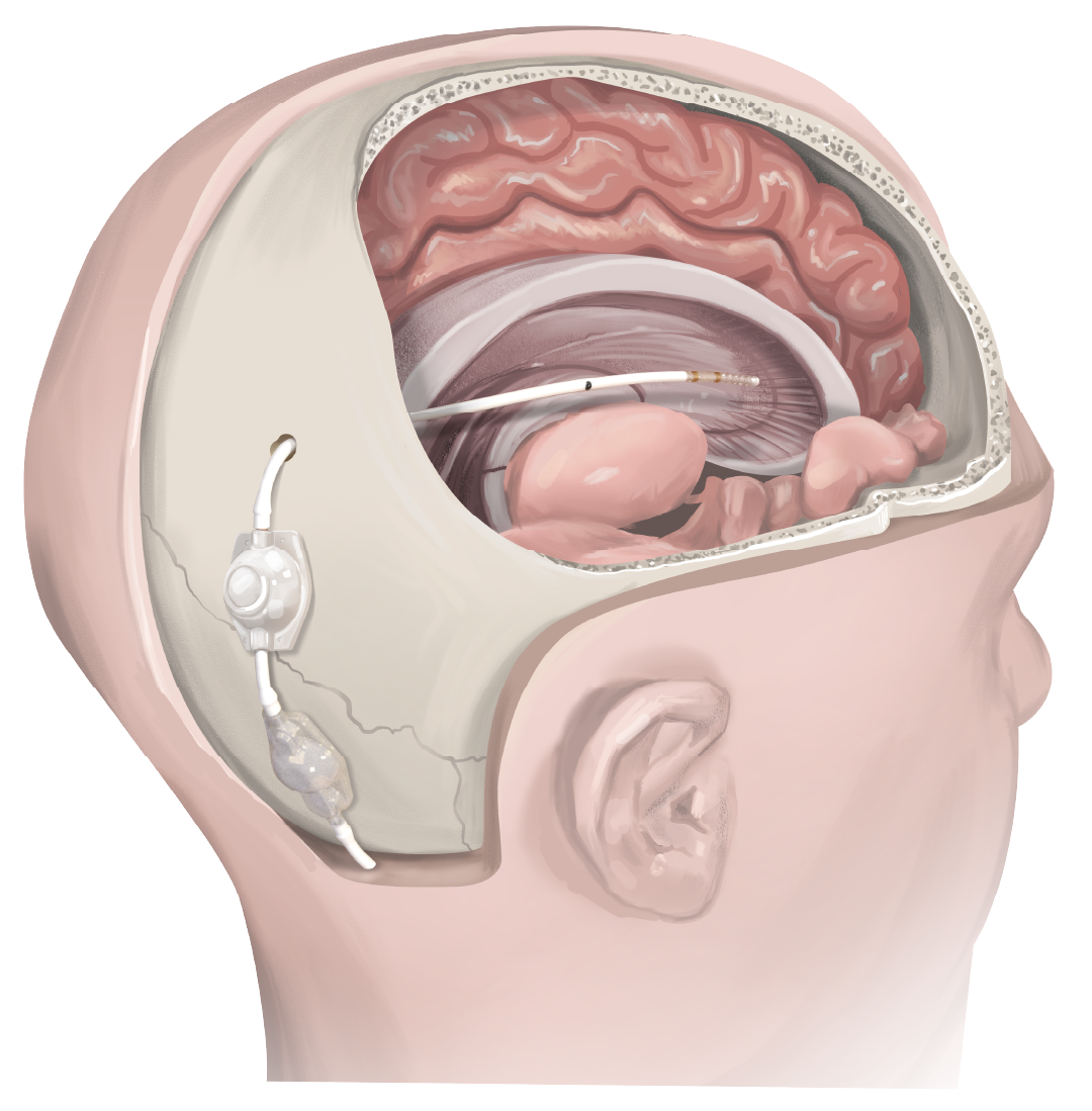 Cross-section of head showing brain and implanted medical device with electrode inside the brain.