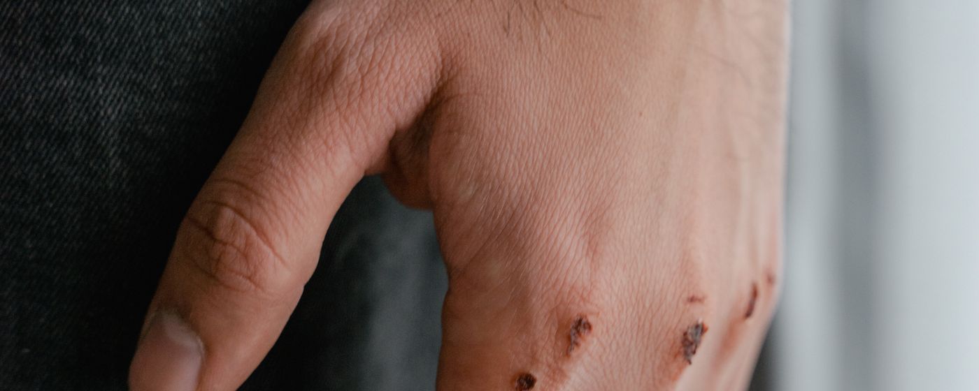 Close up of bruising across a person's skin.