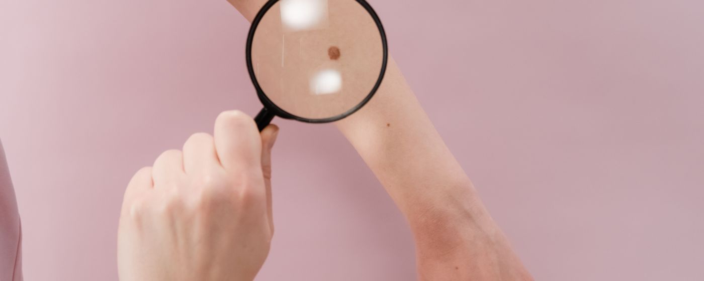 A clinician holding a magnifier over a patch of skin on a person's forearm