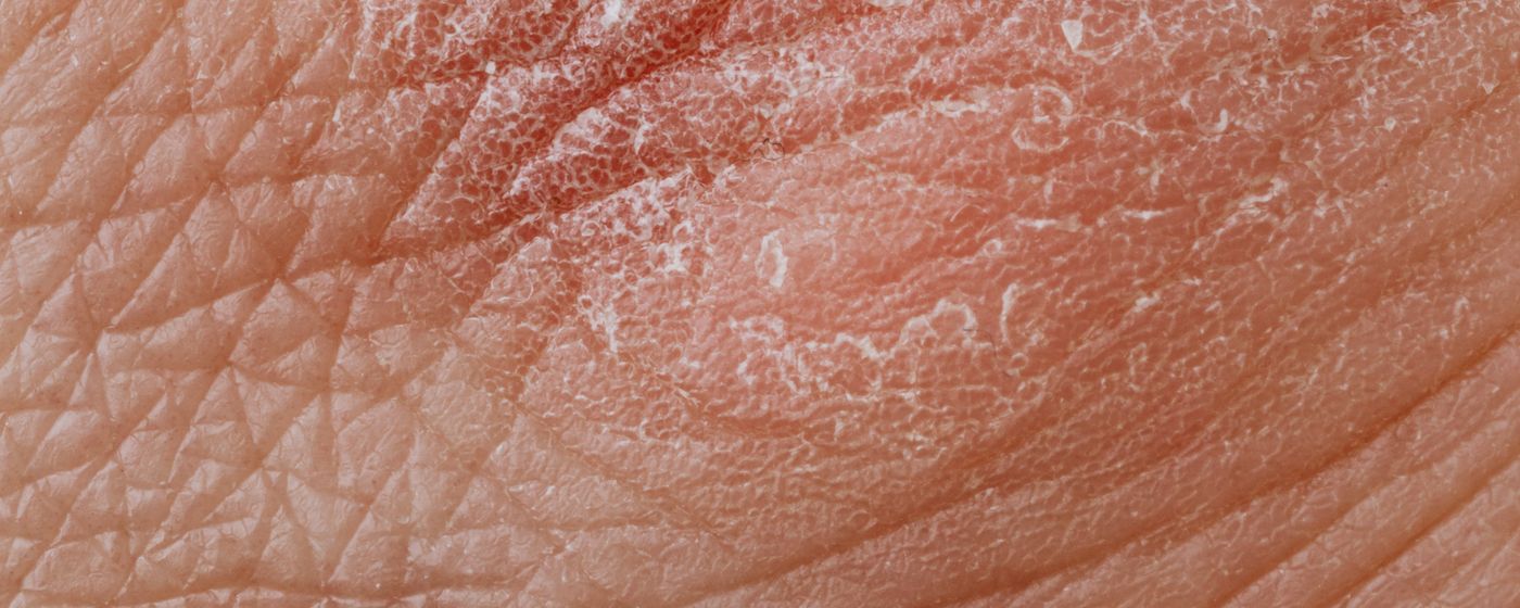 Close-up of dry, reddened skin with cracked and flaking patches