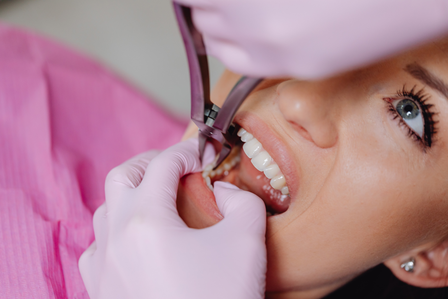 Wisdom Tooth Removal: When You Need an Oral Surgeon Instead of a General Dentist