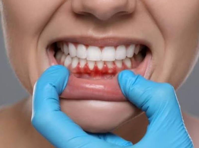 Bleeding Gums: When Is It a Sign of Gum Disease?