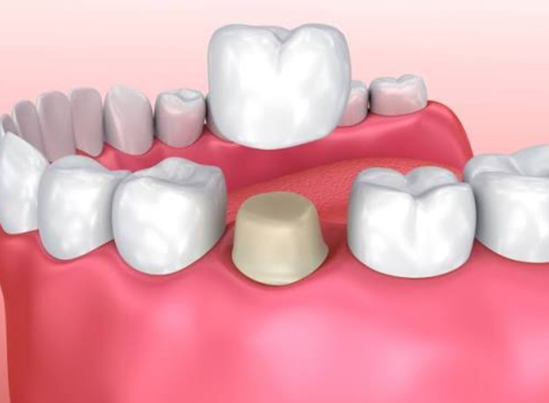 Dental Crown vs Filling: Which Treatment Does Your Tooth Need?