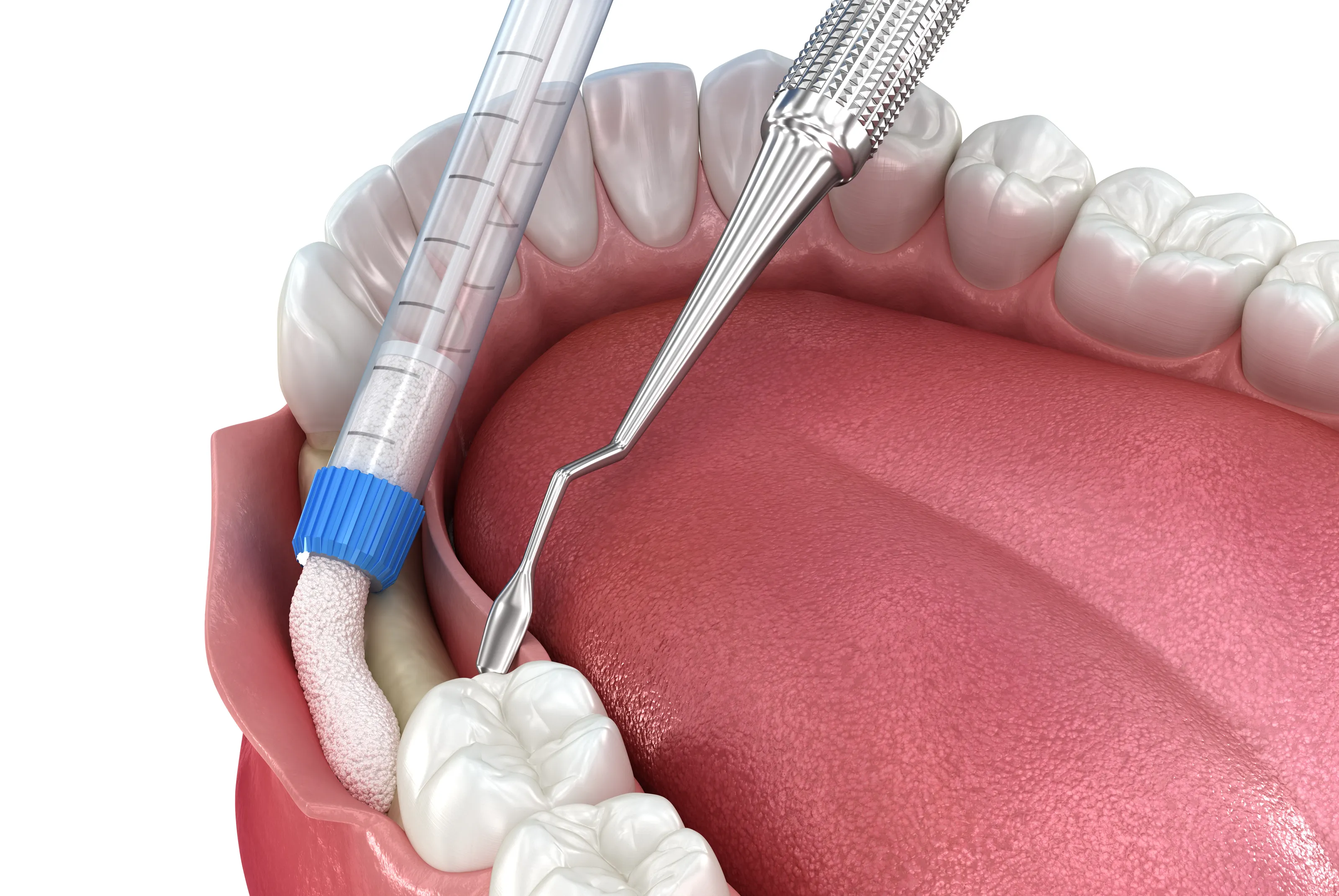 Dental Bone Grafting: When Do You Need It Before a Dental Implant?