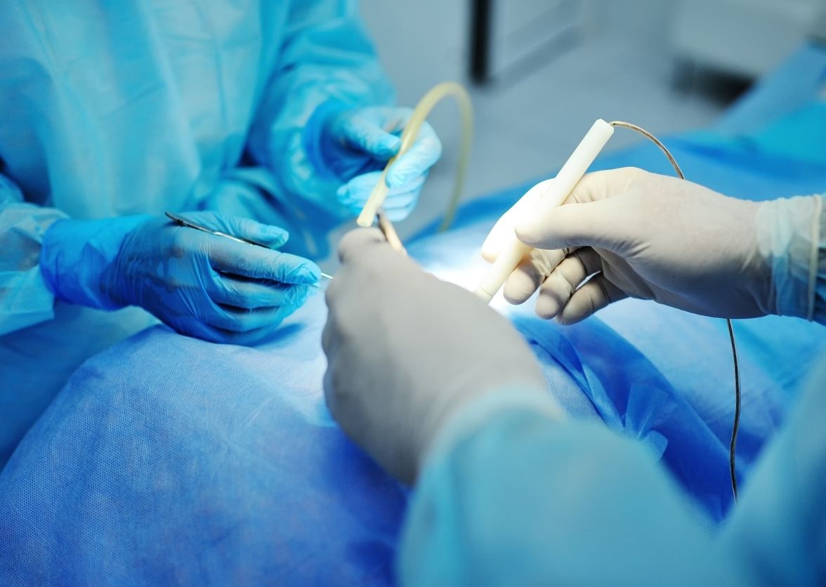 Hemorrhoid Treatment Options Explained