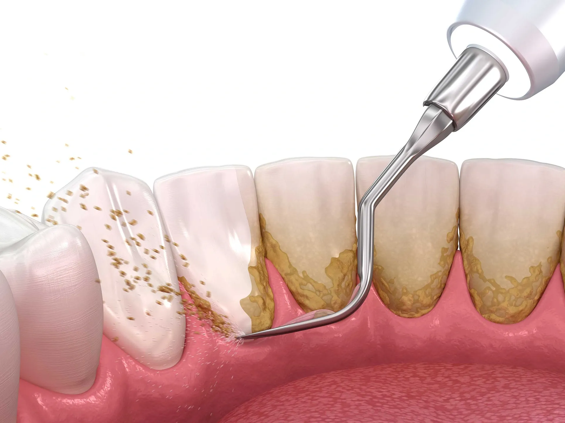Teeth Scaling