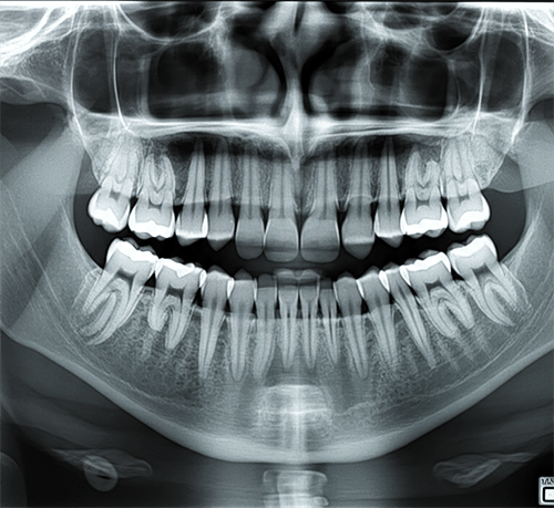 Dental X-Ray