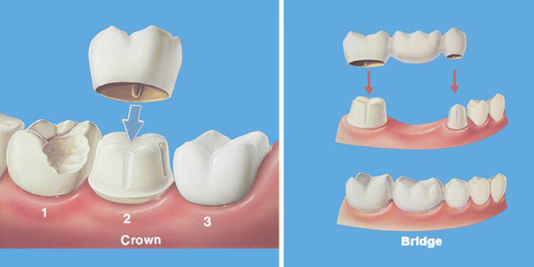 Dental Crowns and Bridges