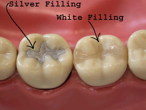 Teeth Filling