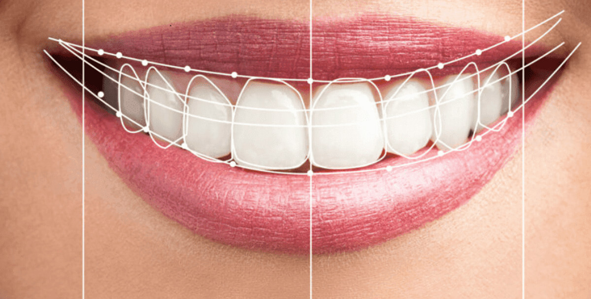 Full Mouth Rehabilitation