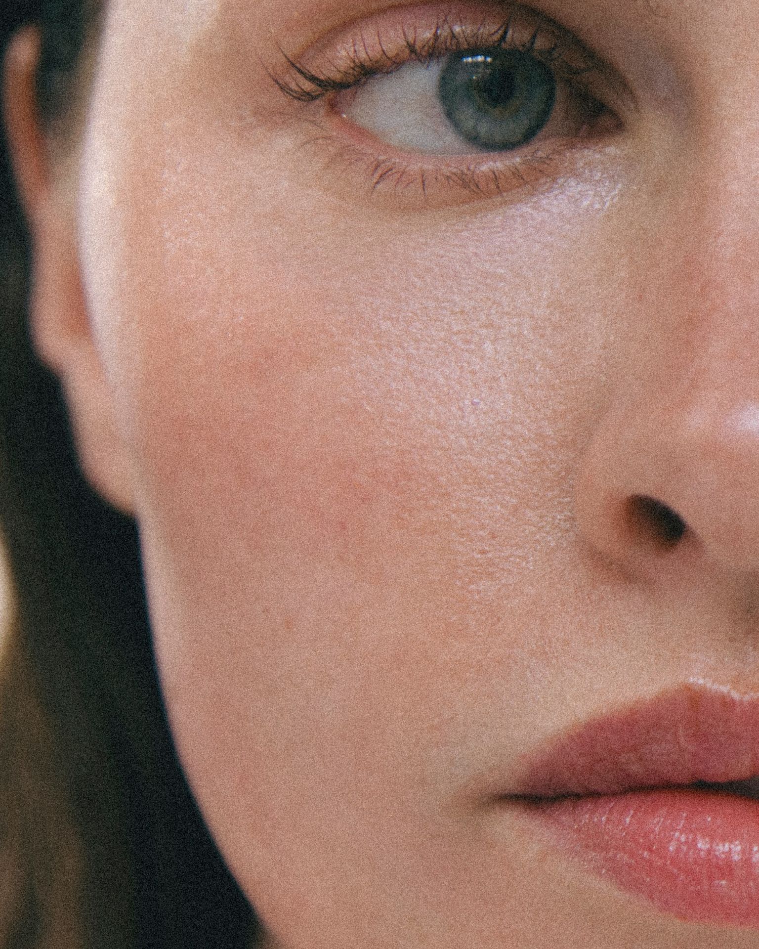 Botox oder Hyaluron? Der Unterschied einfach erklärt