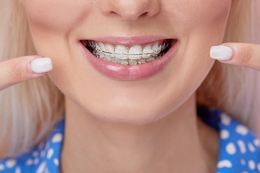 Close-up of a smiling woman pointing at her teeth with clear ceramic braces.