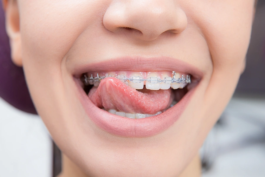 Close-up of a person with metal braces licking their upper teeth with their tongue.