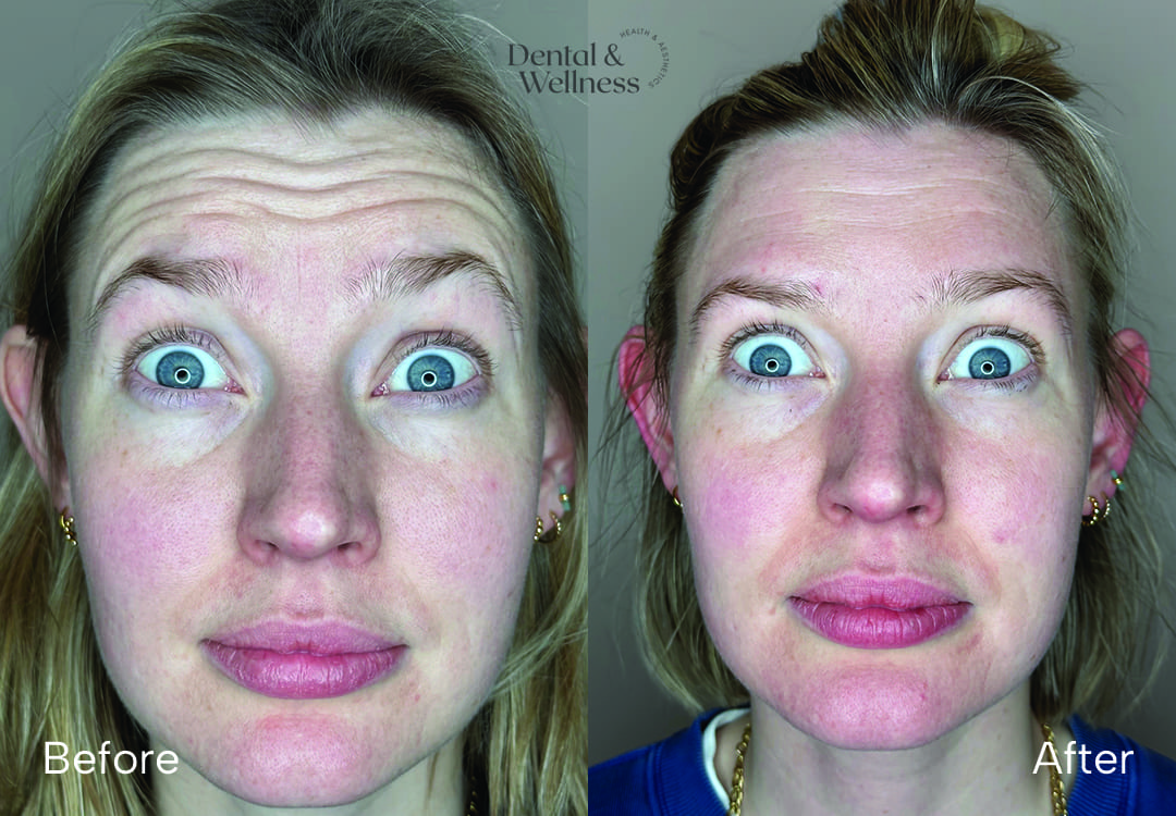 Before and after photos of a woman raising her eyebrows, showing softer forehead lines after treatment