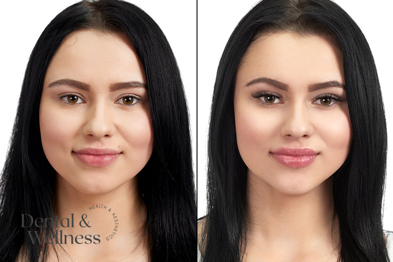 Lip flip before and after: side-by-side portraits of a woman comparing facial proportions before and after treatment