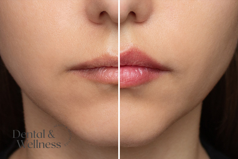 Before and after photo of lips enhanced with a lip flip showing natural results and improved symmetry