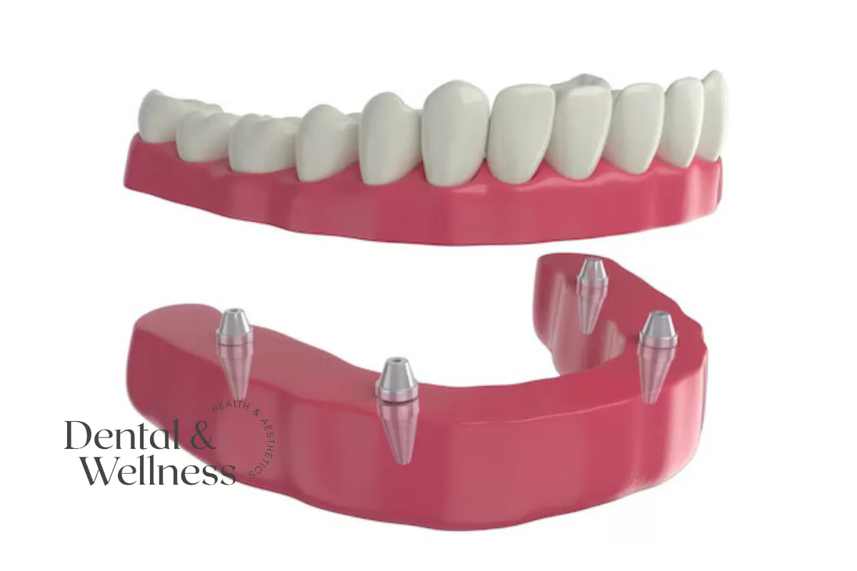 All-on-4 dental implants: model of a full-arch denture above a lower jaw fitted with four dental implants