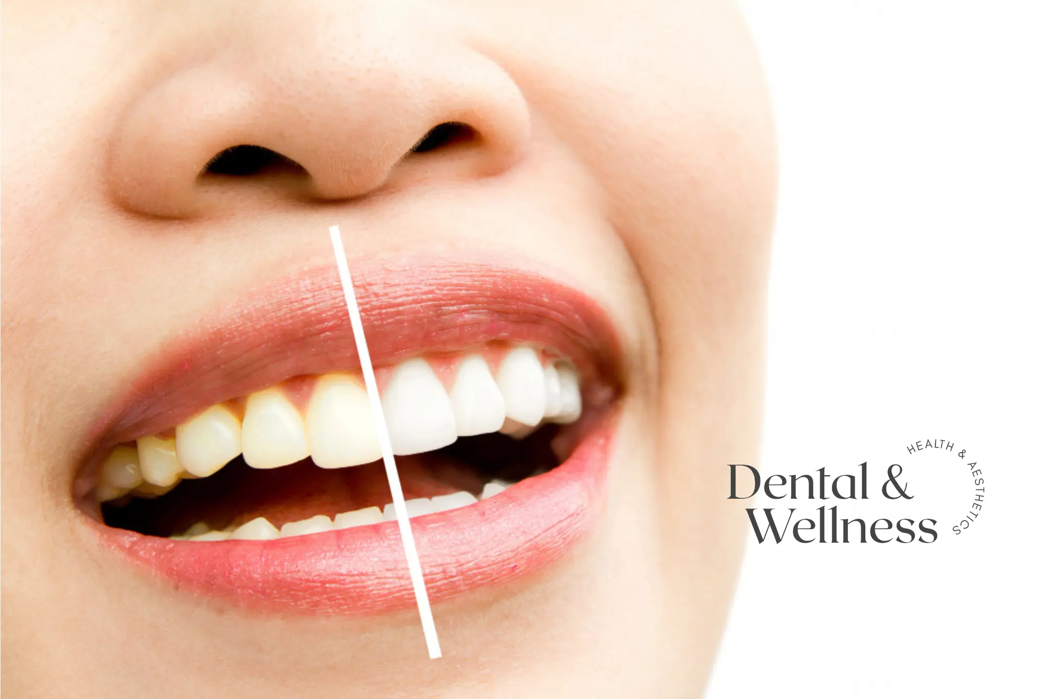 Close-up of a smile split down the middle to compare tooth shade before and after whitening — teeth whitening strip safety