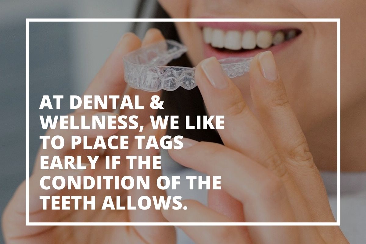 Graphic about Invisalign attachments over a woman fitting a clear aligner