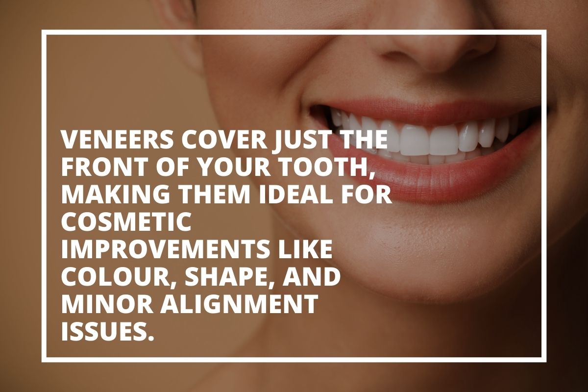 Graphic explaining that veneers cover the front of the tooth to improve colour, shape and minor alignment