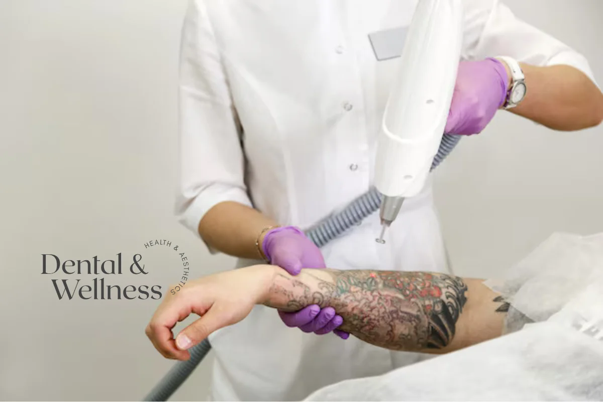 Clinician removing a forearm tattoo with a laser handpiece