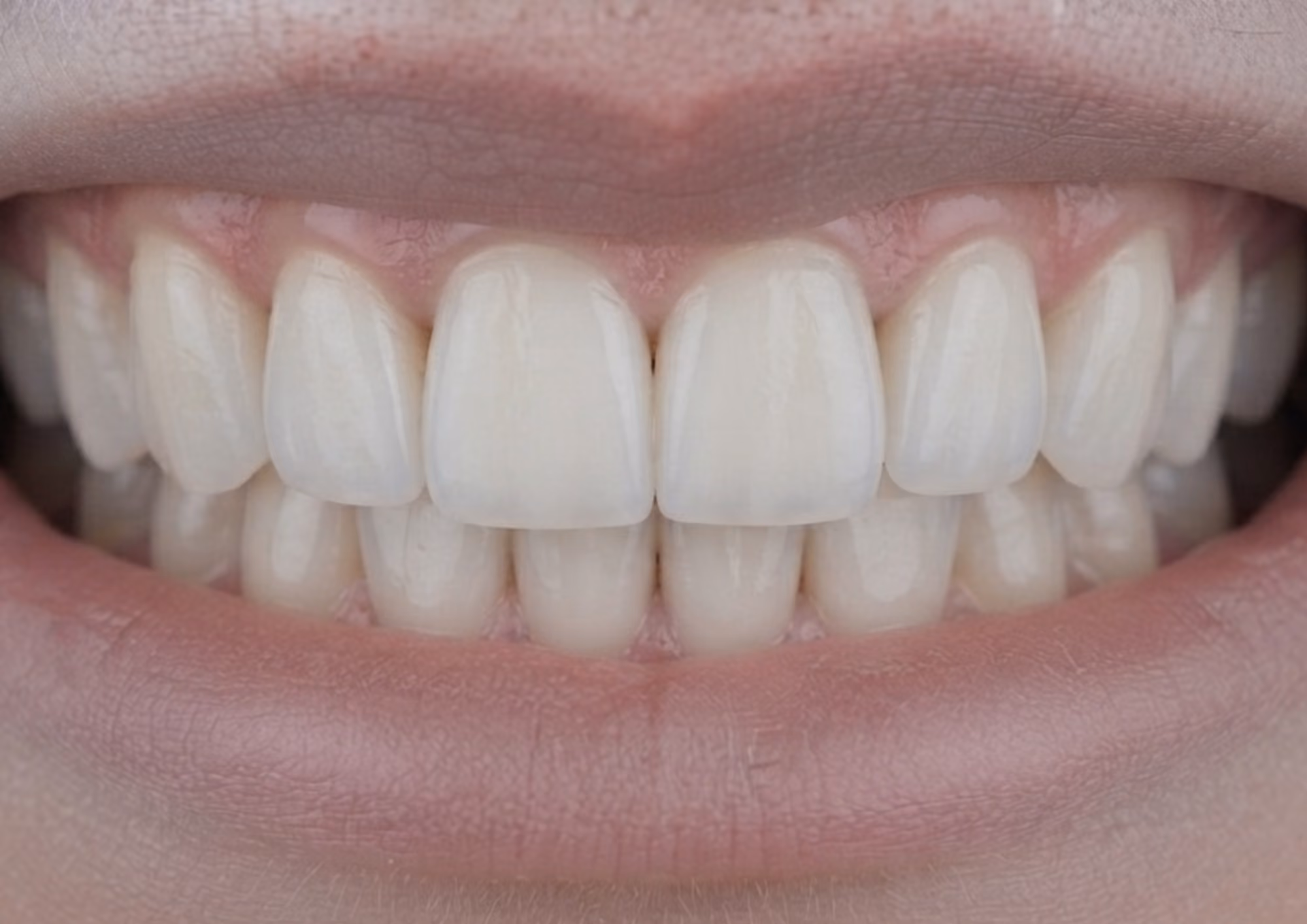 After veneers at Dental & Wellness London, Islington