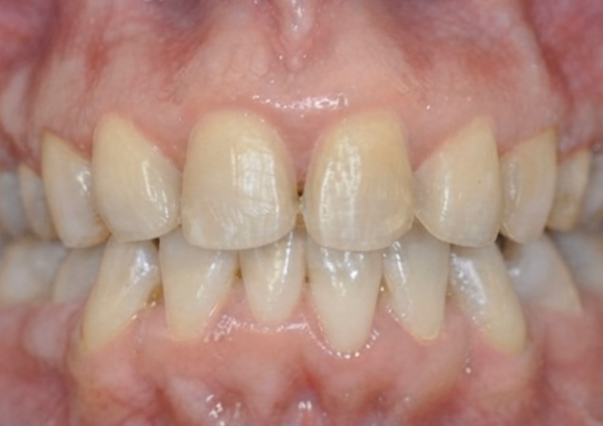 Before veneers at Dental & Wellness London, Islington