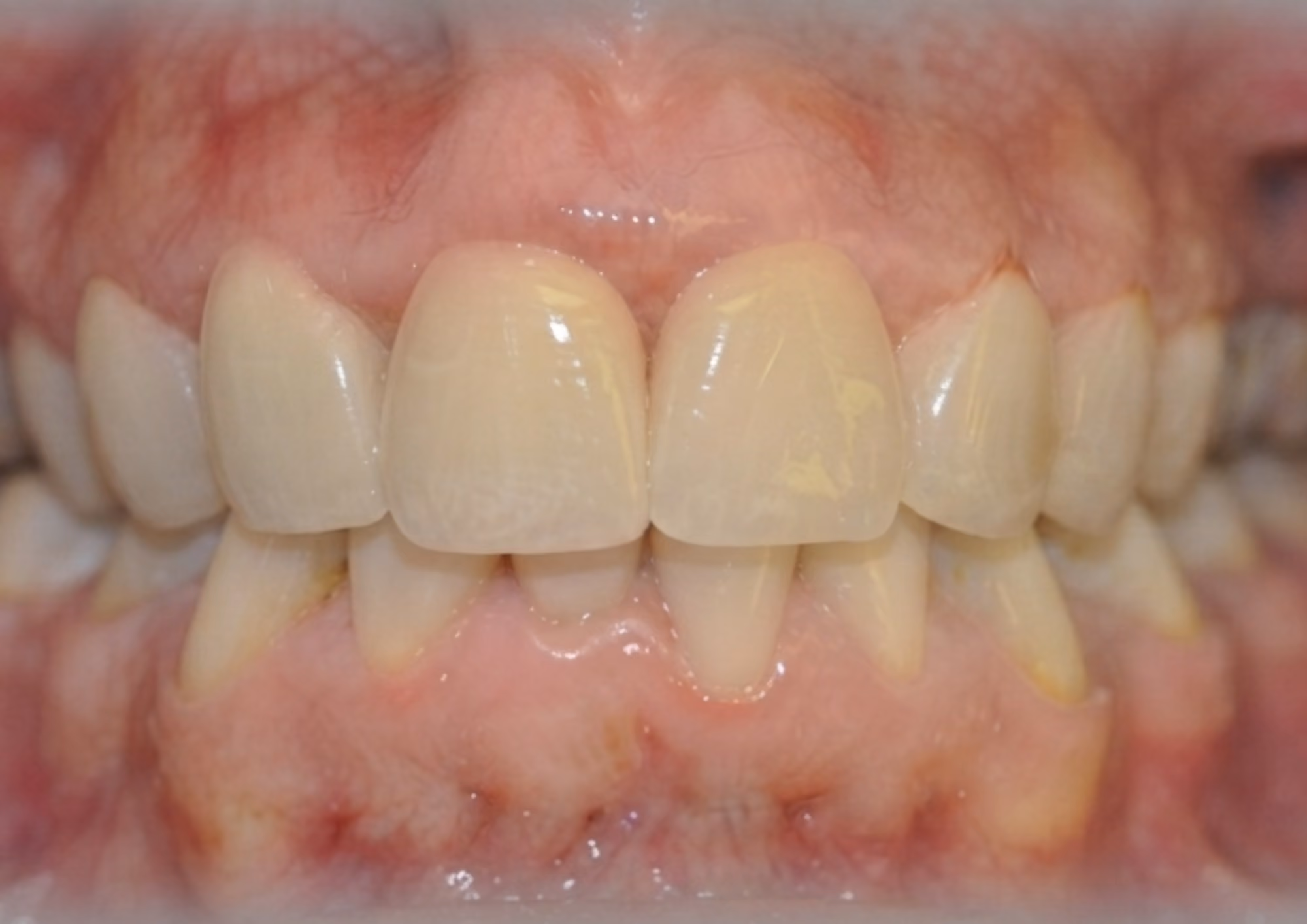 After veneers at Dental & Wellness London, Islington