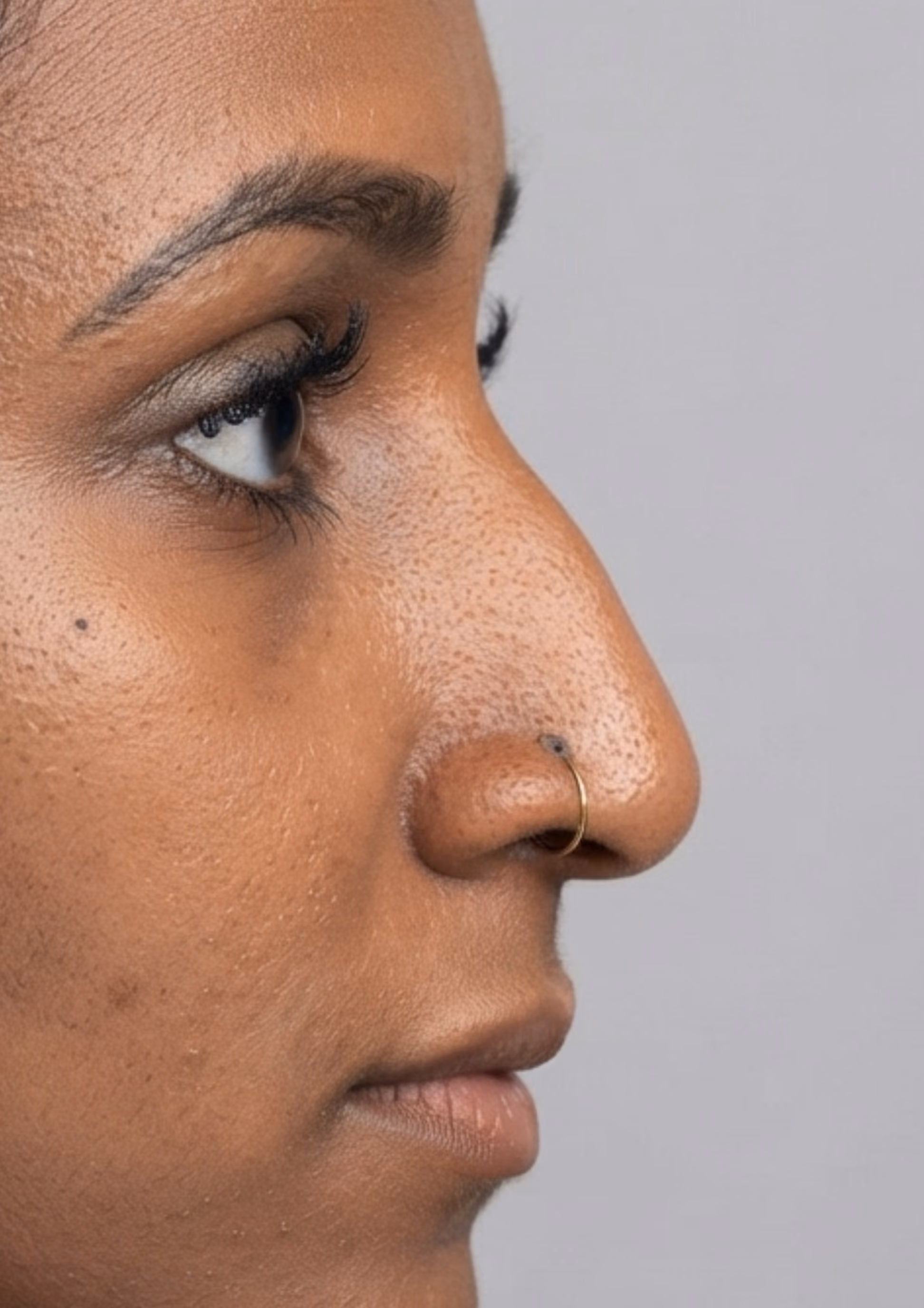 Before non-surgical nose reshaping at Dental & Wellness London, Islington