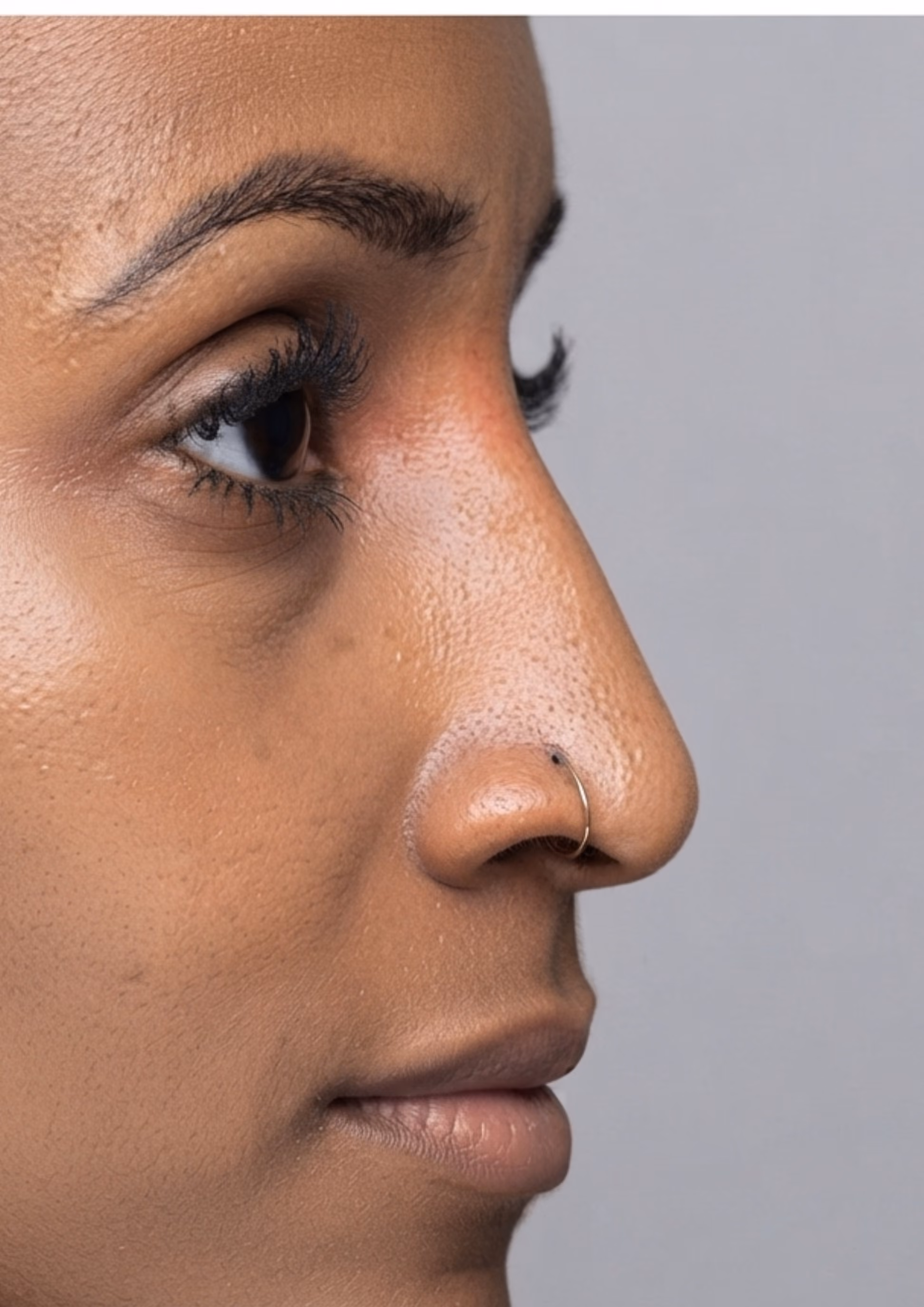 After non-surgical nose reshaping at Dental & Wellness London, Islington
