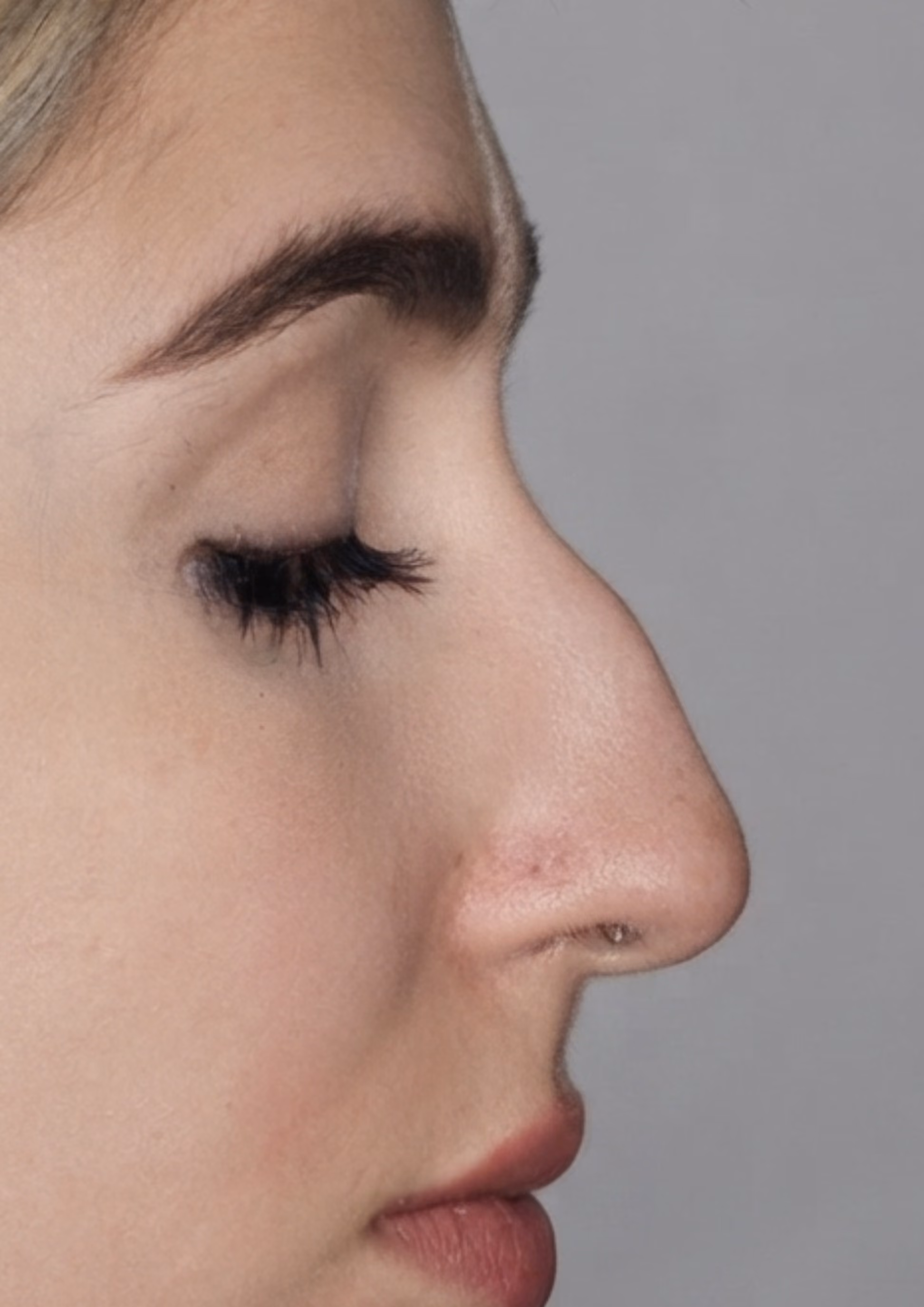 Before non-surgical nose reshaping at Dental & Wellness London, Islington