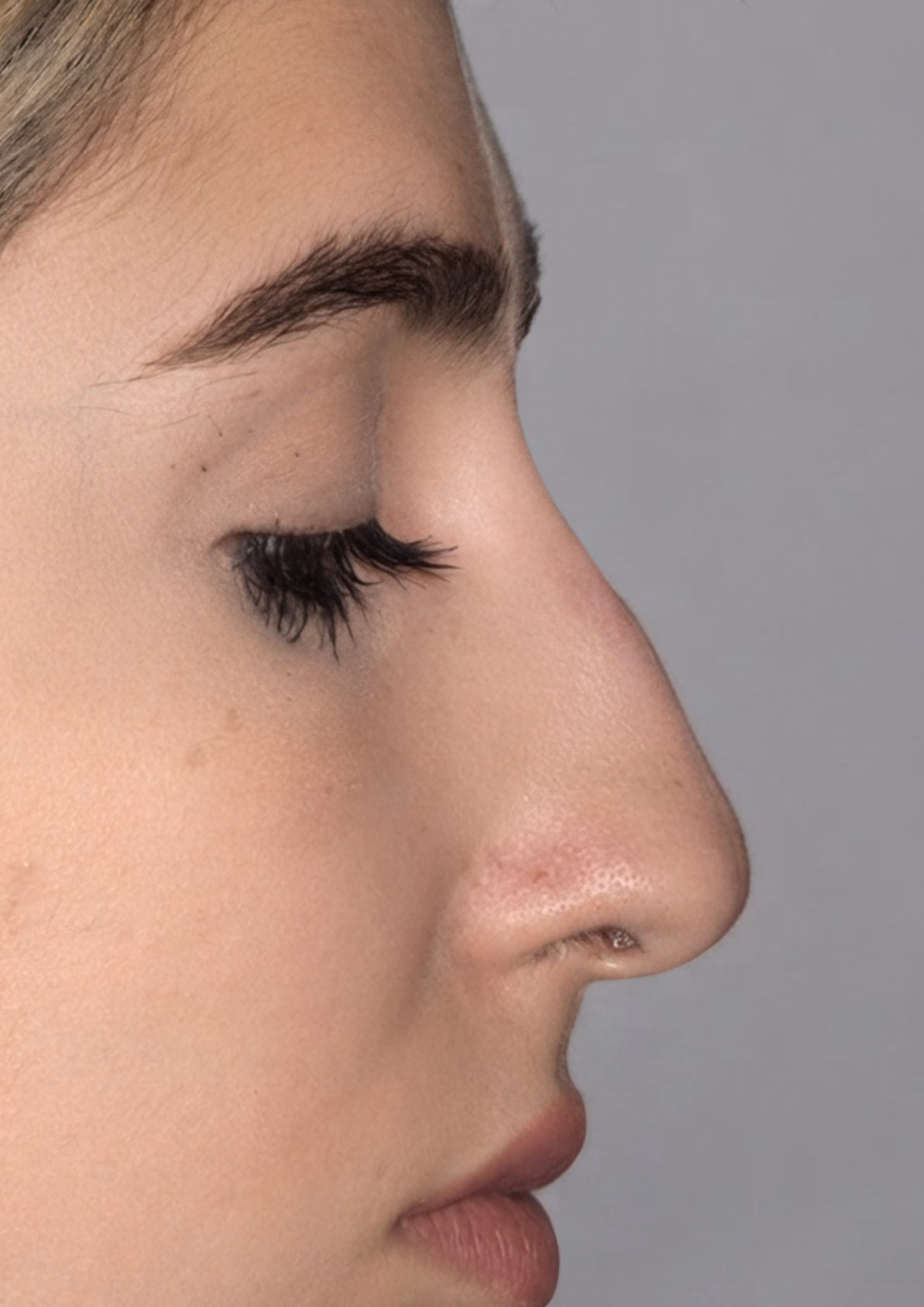 After non-surgical nose reshaping at Dental & Wellness London, Islington