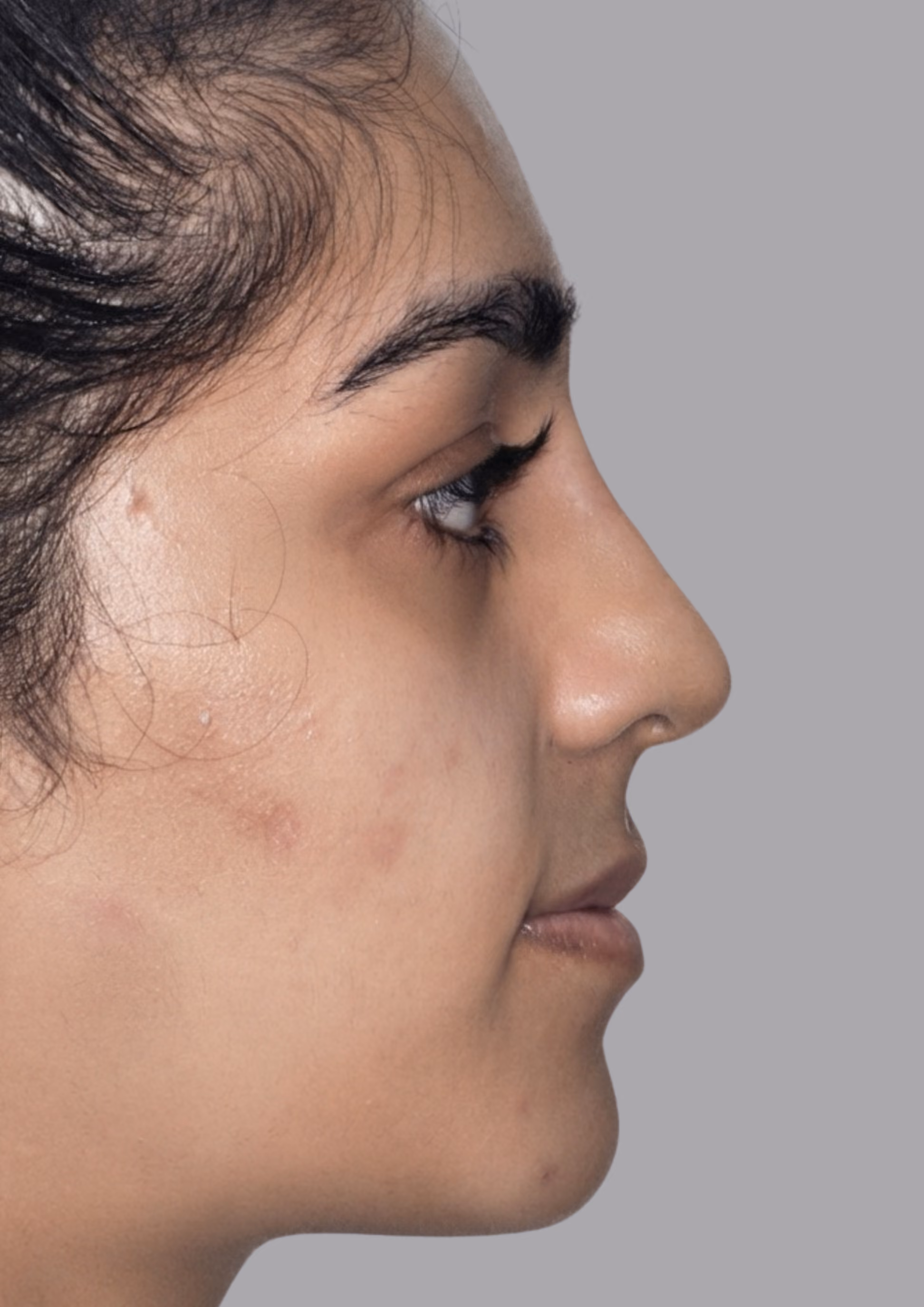 After non-surgical nose reshaping at Dental & Wellness London, Islington
