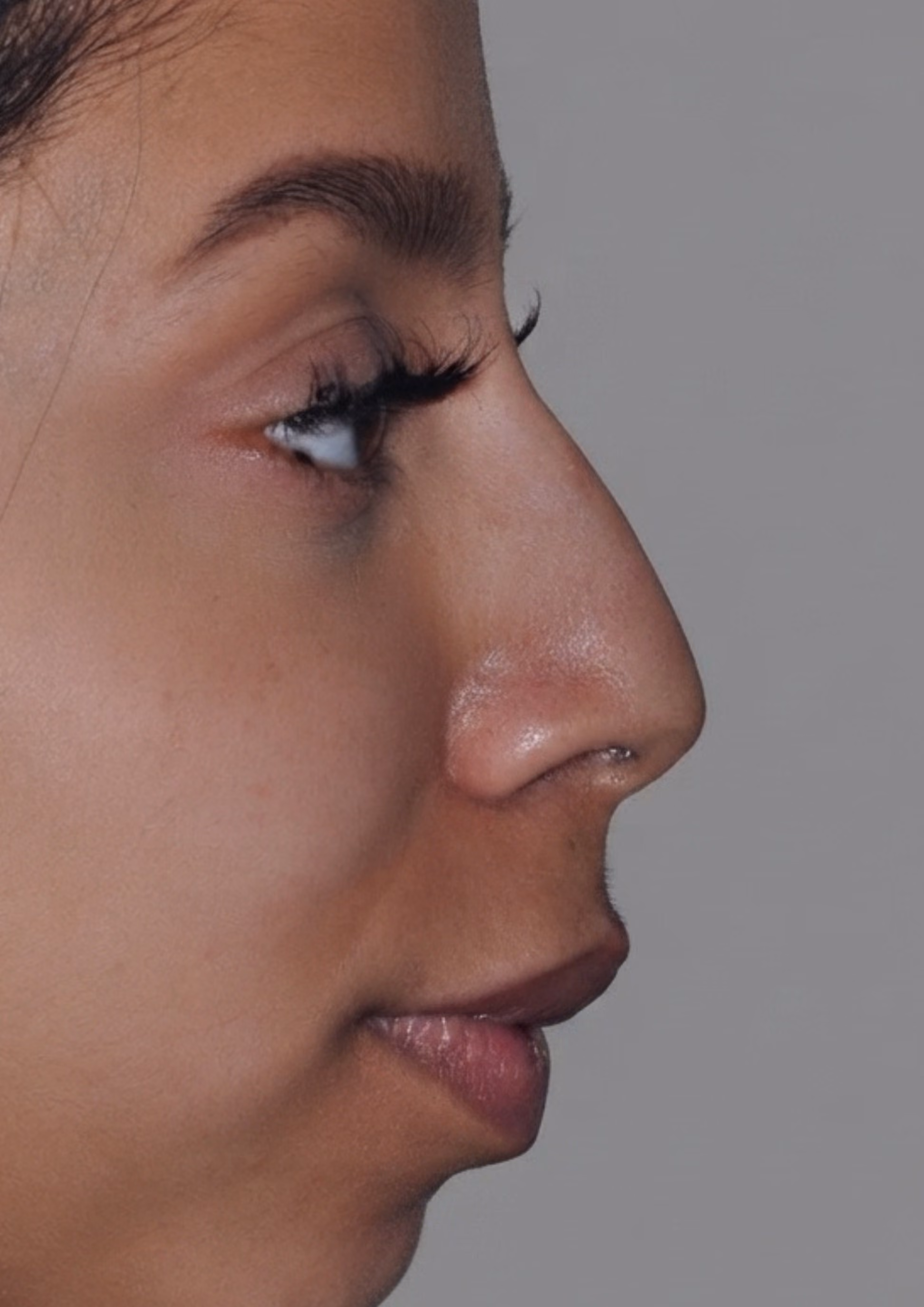 Before non-surgical nose reshaping at Dental & Wellness London, Islington